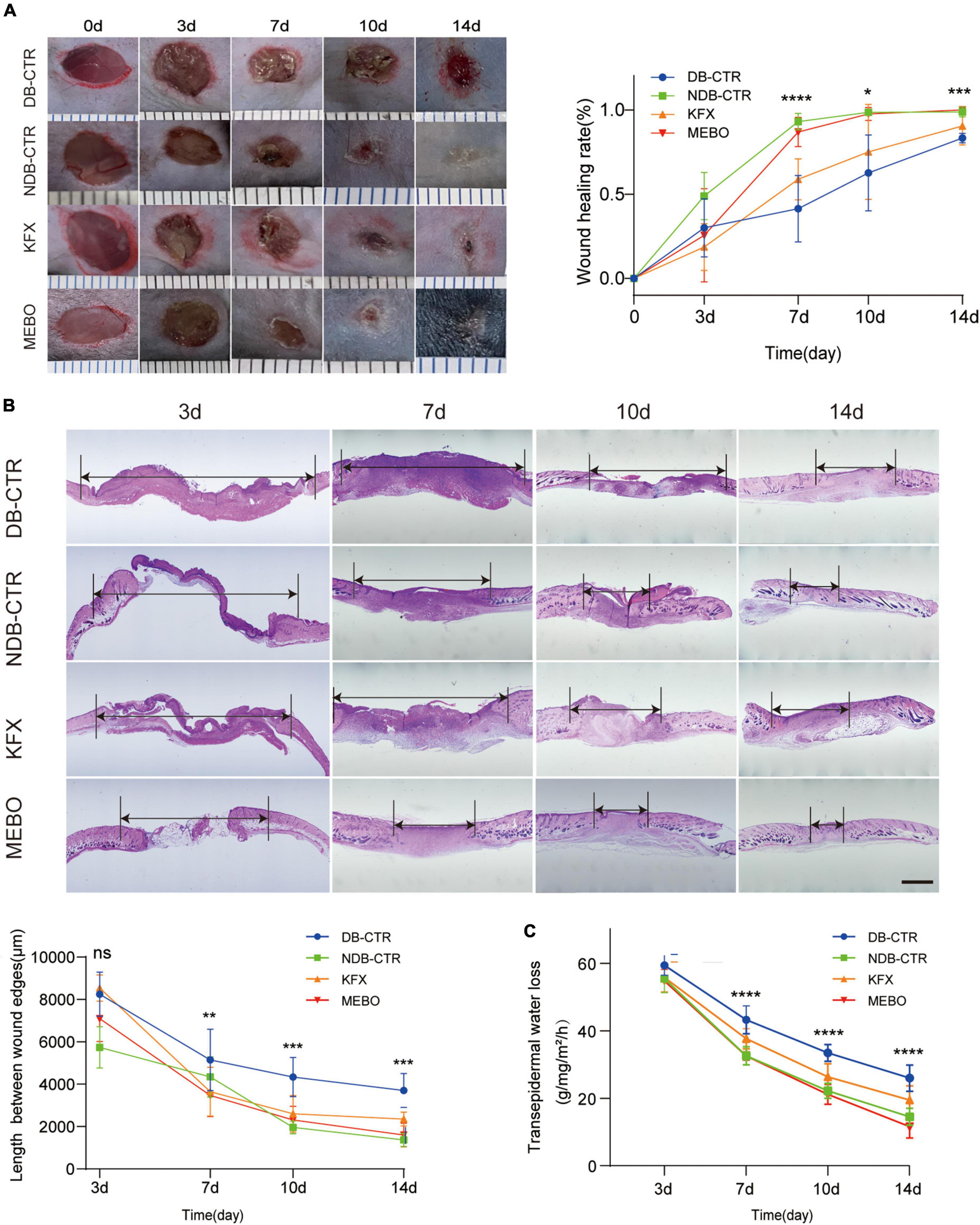 Moist exposed burn ointment accelerates diabetes-related wound healing by promoting re-epithelialization